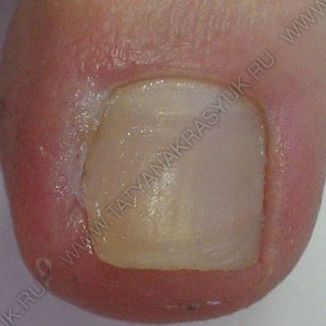 лечение вросшего ногтя воспаление с нагноением